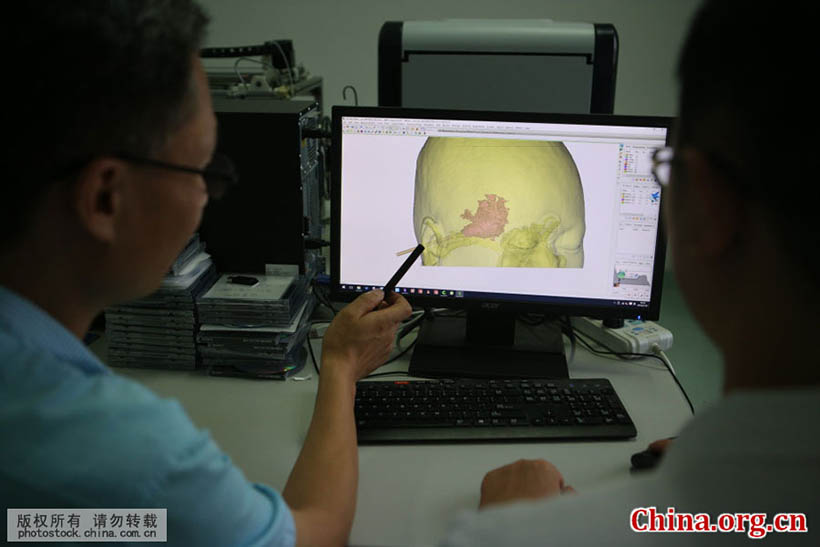 Cirurgia cerebral com tecnologia de impressão 3D é realizada em Shandong