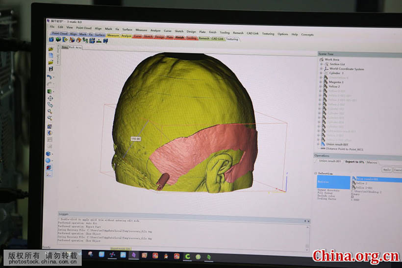 Cirurgia cerebral com tecnologia de impressão 3D é realizada em Shandong