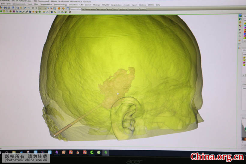 Cirurgia cerebral com tecnologia de impressão 3D é realizada em Shandong