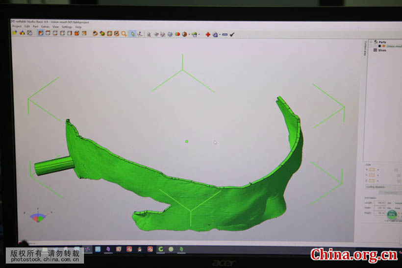 Cirurgia cerebral com tecnologia de impressão 3D é realizada em Shandong